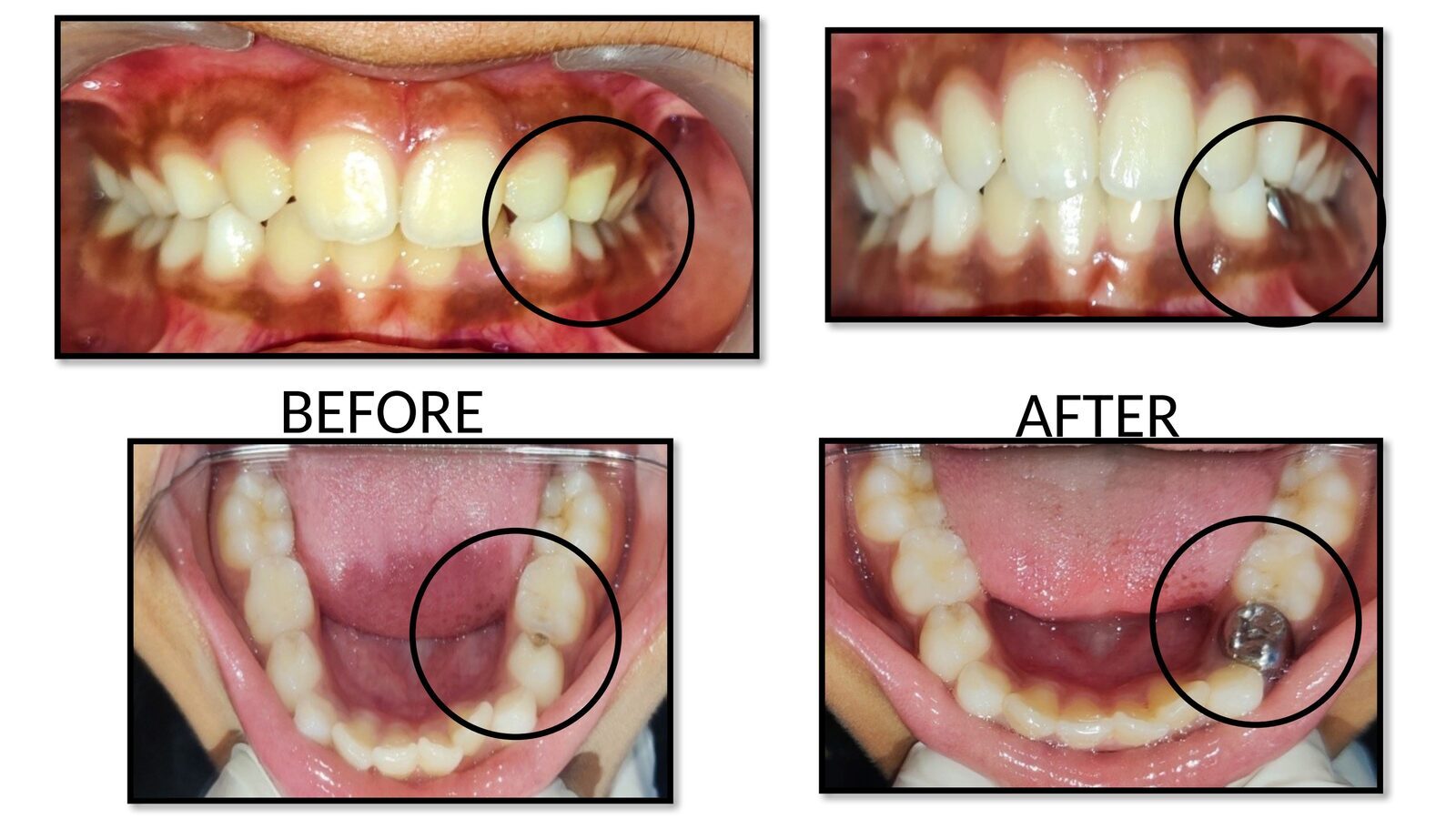 Before and after pediatric dental treatment showing root canal treatment (pulp therapy) and stainless steel crown placement on a lower molar