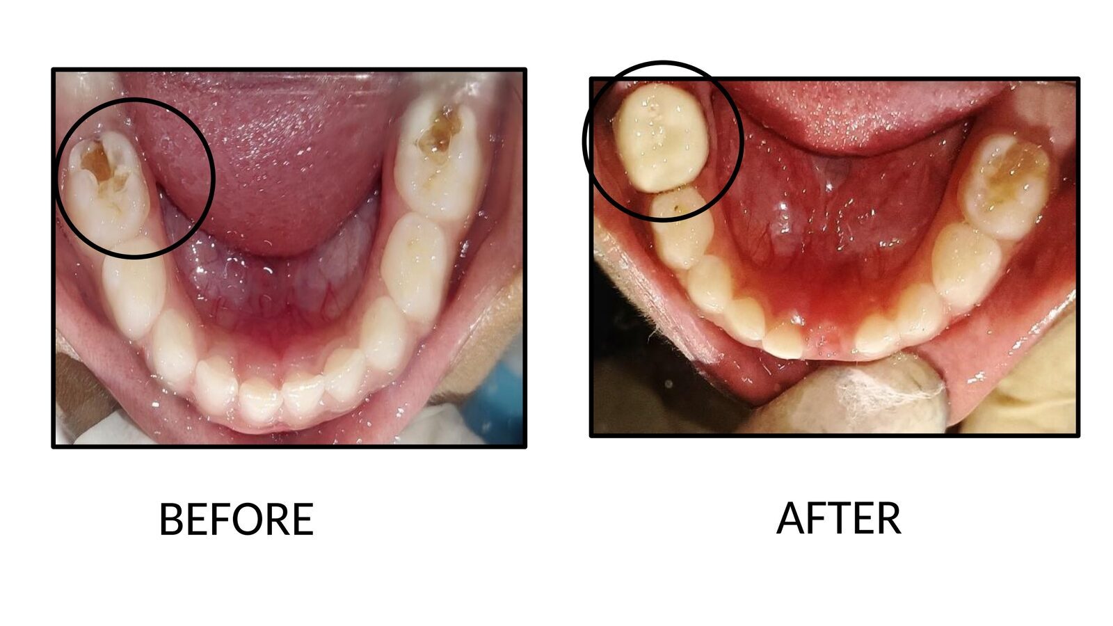 Before and after pediatric treatment showing root canal therapy (pulp therapy) and BioFlx crown (aesthetic crown) on a lower baby molar