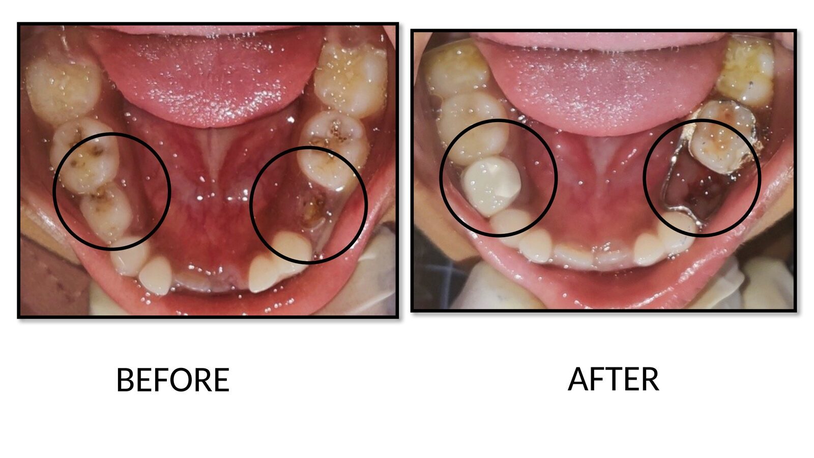 Before and after pediatric treatment with aesthetic crown and band-and-loop space maintainer on lower molars