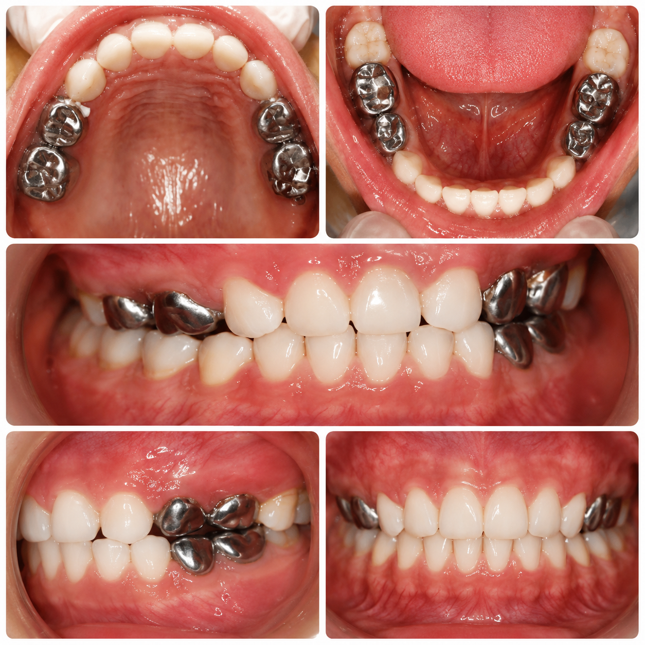 After full mouth rehabilitation with stainless steel crowns and space maintainer