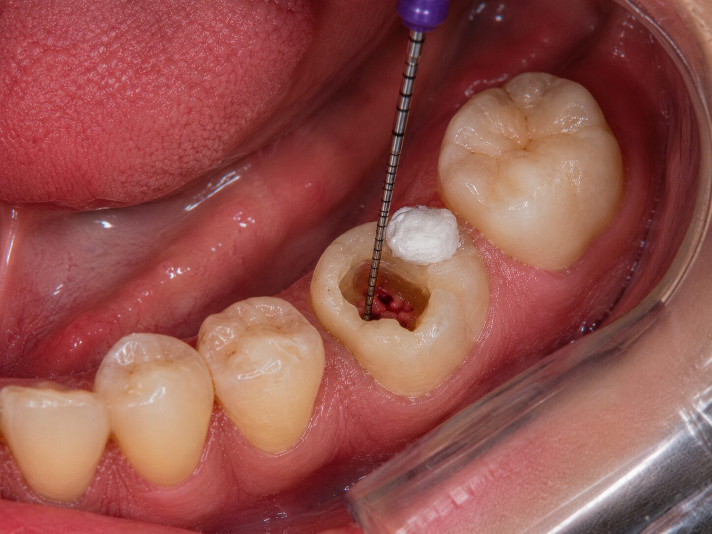 Pulp Therapy (Baby Root Canal)