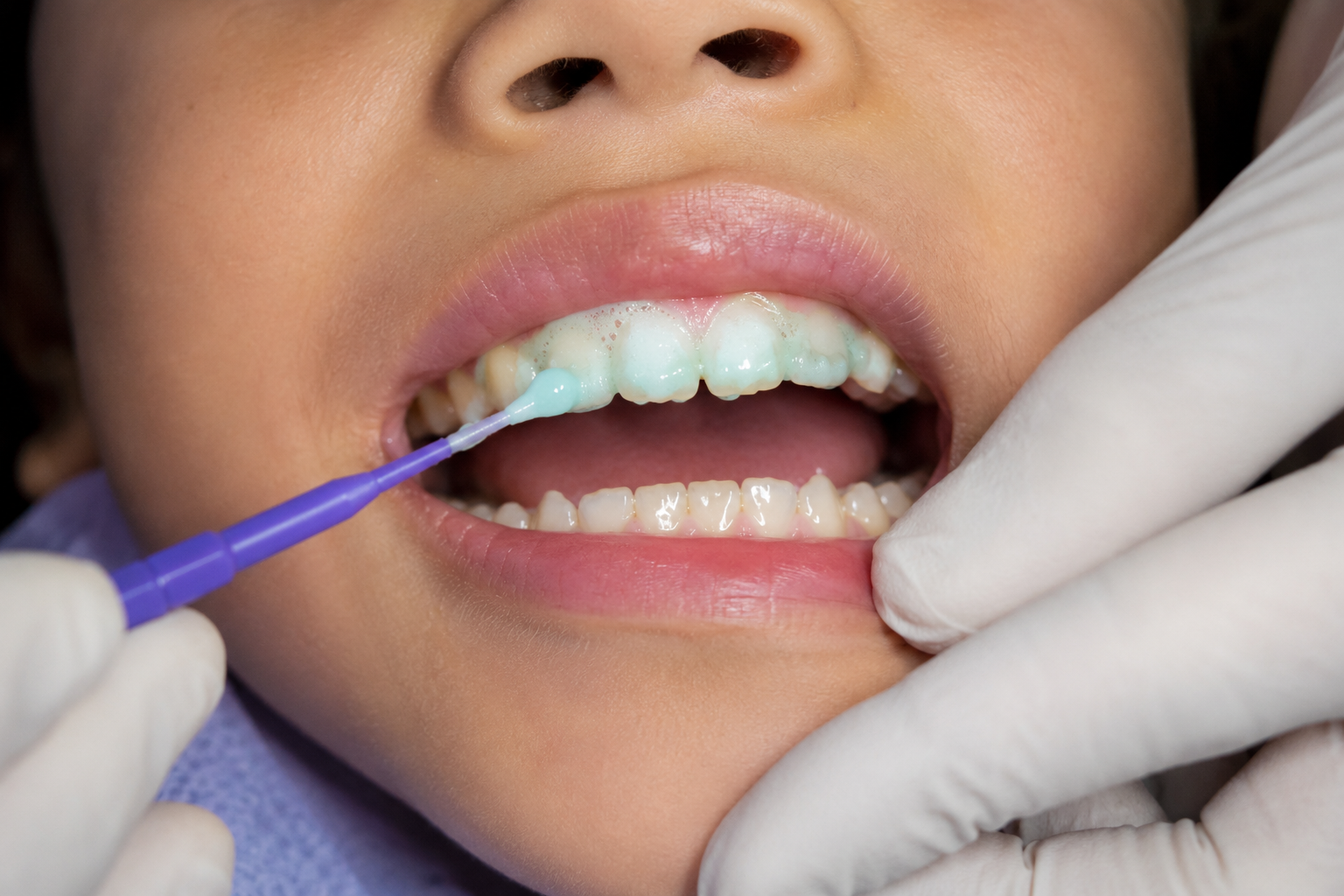 Fluoride Treatment